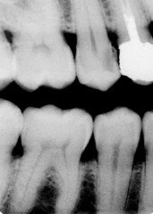 Advanced caries- C4 on number 4