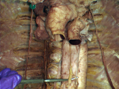 anterior esophageal plexus
