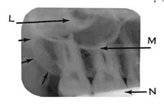 Floor of maxillary sinus