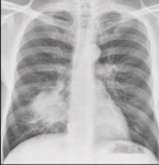 Lung Cancer CXR