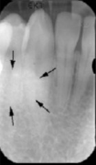 mandibular tori 

(radiopacity superimposed over the roots in the canine region)