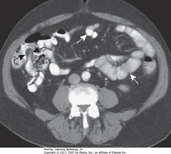 NORMAL BOWEL
• Contrast fills nondilated lumen of small bowel (< 2.5 cm)
• WA: small bowel wall - thin - normally almost invisible 
• BAs: terminal ileum - recognized by the fat-containing 