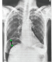 Pneumoperitineum (air under the diaphragm) on right; left is gastric air bubble
