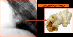 'Popcorn calcificatoin' is seen in a. Tuberculosis b. Carcinoid c. Hamartoma d. Teratoma
