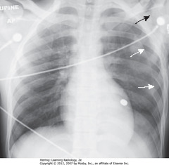 PTX WITH NO SHIFT
• SWA: Large L PTX - with no shift of heart or trachea to right
• SBA: SQ emphysema in region of left shoulder
• Bullet superimposed on heart