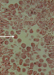 entamoeba histolytica
(trophozoa with ingested RBCs)